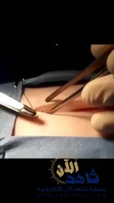 جراحة عاجلة تنقذ “سعودية” من تورم ضخم