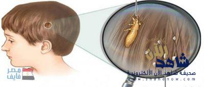 طريقة طبيعية فعالة وسريعة للقضاء على قمل الشعر نهائياً خاصه لدى الاطفال