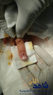 أطباء ينجحون في إعادة ” إصبع مبتور ” لطفل السادسة في مستشفى سلوى العام