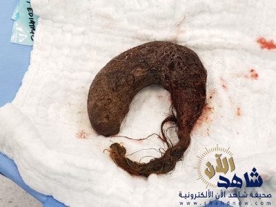 فتاة الأربع سنوات تتغذى على شعرها