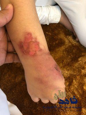 صور صادمة.. حروق تشوه الطالبة ريتاج !