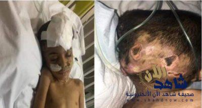 مواطن ينشر صور بشعة لأثار التعذيب على جسد طفل بخميس مشيط.. ويكشف عن هوية الجاني