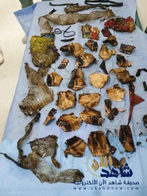 كرة قدم وبالونات.. استخراج 30 قطعة بلاستيكية من بطن شاب بجدة “صور”