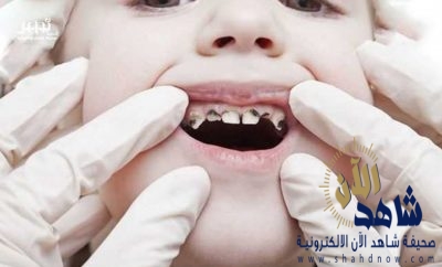 الصحة: 40% تسوس الأسنان بالمدارس.. و200 عيادة محمولة لفحص الطلاب