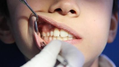 طبيبة أطفال: المشروبات الغازية تضر بالأسنان وهناك بدائل أكثر فائدة منها