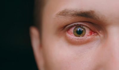 4 نصائح لتجنب احمرار العين في المسابح.. روشتة مستشفى العيون التخصصي