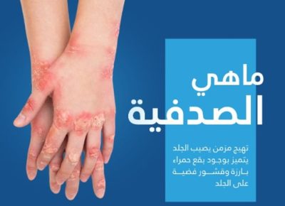 5 مهيجات و5 لتقليل الأعراض.. مرض “الصدفية” في إيضاح لـ”صحي القصيم”